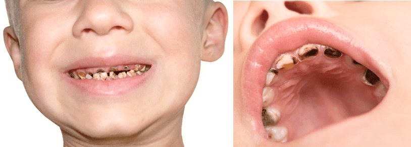 Dental Caries Example